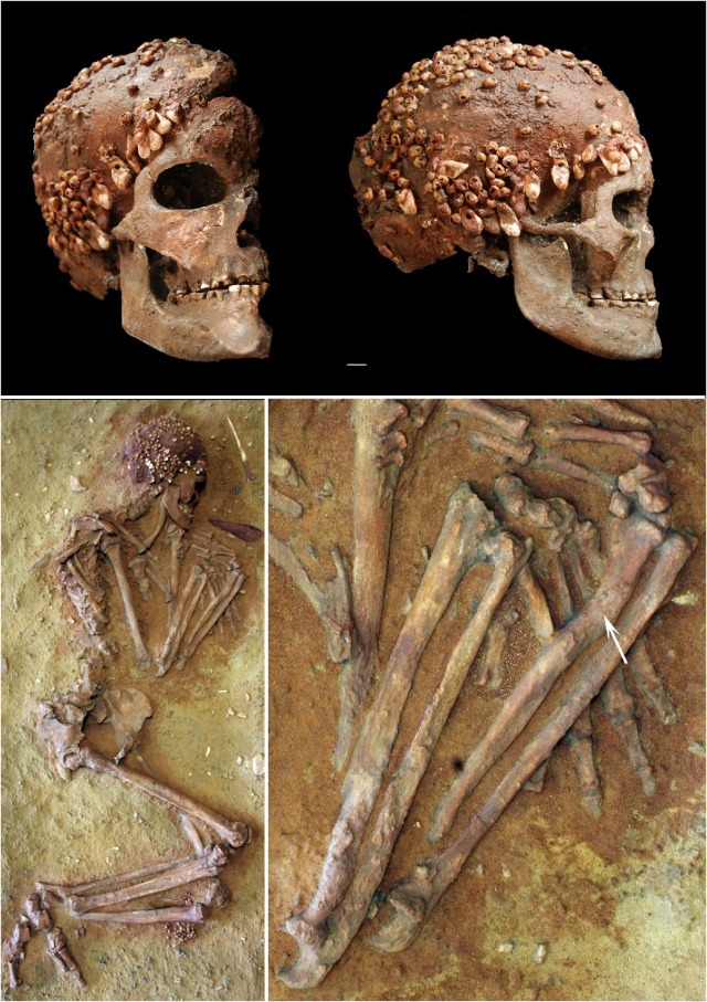 Trauma in the upper limb of an Upper Paleolithic female from Caviglione  cave (Liguria, Italy): Etiology and after-effects in bone biomechanical  properties - ScienceDirect