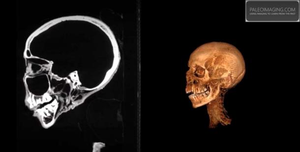 Screenshot from CT reconstruction produced by Paleo Imaging using RadiANT DICOM viewer, revealed the brain has been removed as is usual with Egyptian mummies. (Paleoimaging.com)