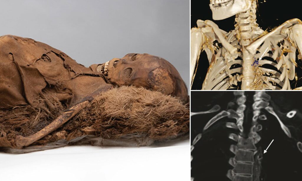 Uncovering the Mysteries of Atherosclerosis: Ancient Mummies Challenge Our Understanding