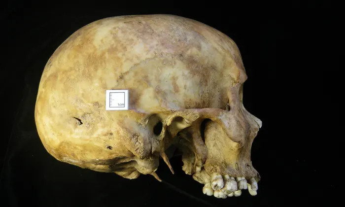 The skull of a female who died as a result of a stab wound to the head.