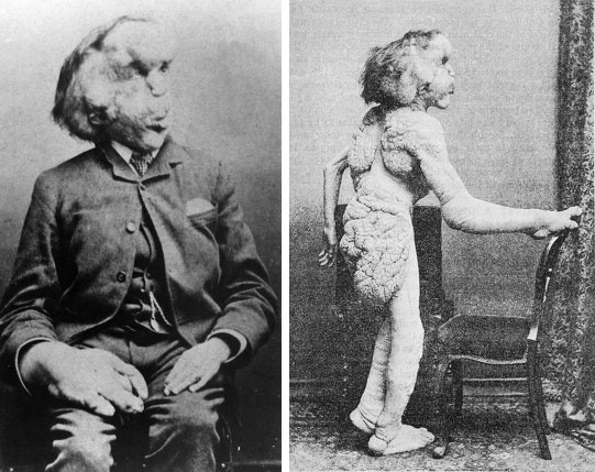 The Elephant Man’s Story: Inspiring Generations Through Resilience and Empathy