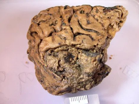 Unlocking Secrets: The Remarkably Preserved 2,600-Year-Old Brain and Its Impact on Brain Disease Research