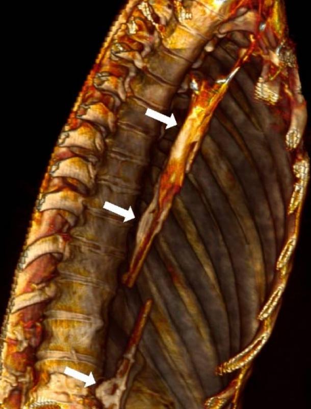 Uncovering the Ancient Origins of Heart Disease: How Mummies Reveal a Timeless Affliction