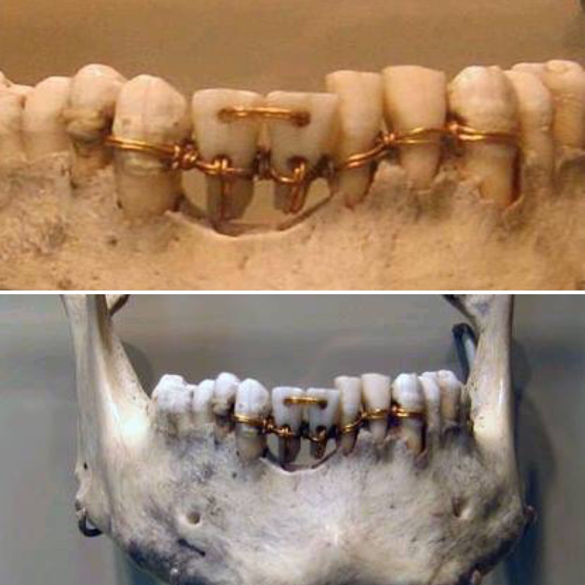 Ancient Egyptian dental work from 2000 BC. : r/Damnthatsinteresting